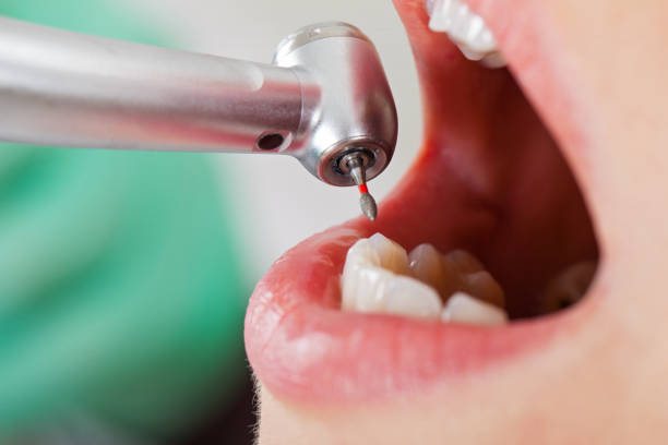 Best Lost Filling or Crown Replacement in Apple Valley, MN